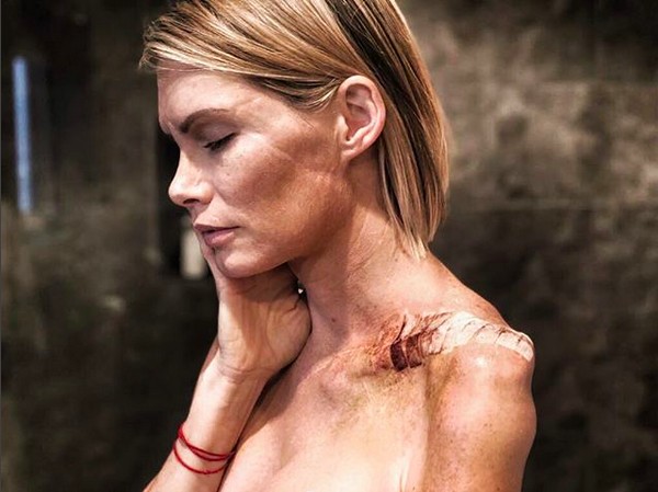 A dublê Olivia Jackson mostrando as lesões decorrentes do acidente no set de Resident Evil (Foto: Instagram)