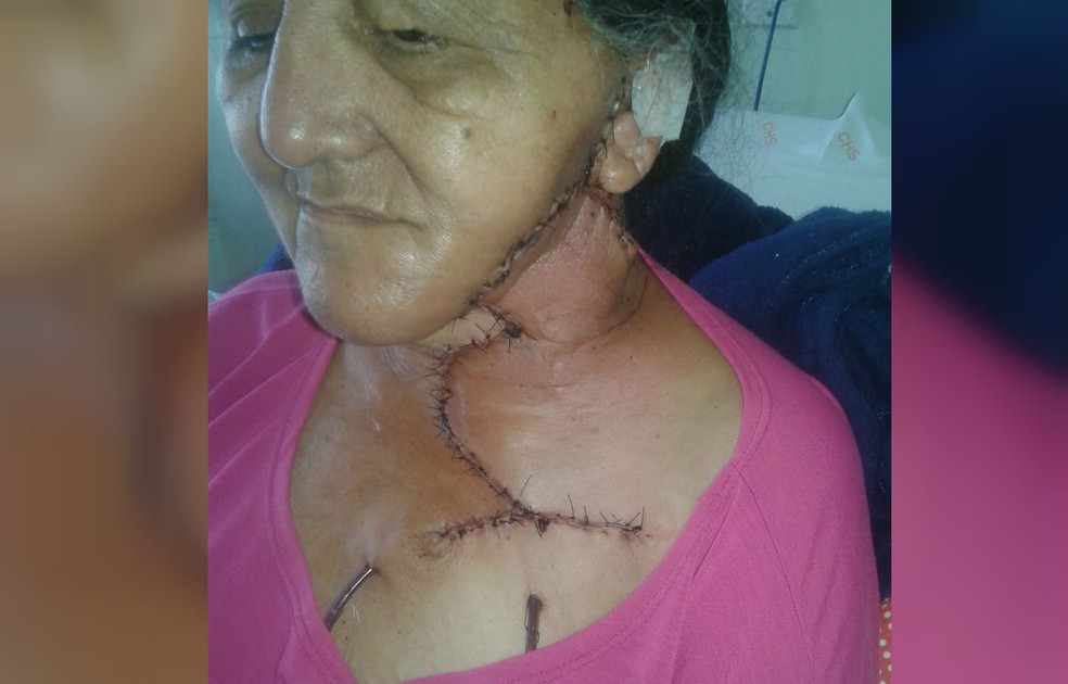 Voltarei A Viver Diz Costureira Apos Cirurgia Para Retirar Tumor Gigante Do Pescoco Sorocaba E Jundiai G1