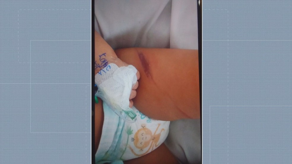 Machucados encontrados na criança de 8 meses encontrada ao lado do corpo da mãe no Centro de São Paulo, após feminicídio registrado pela polícia.  — Foto: Reprodução/TV Globo