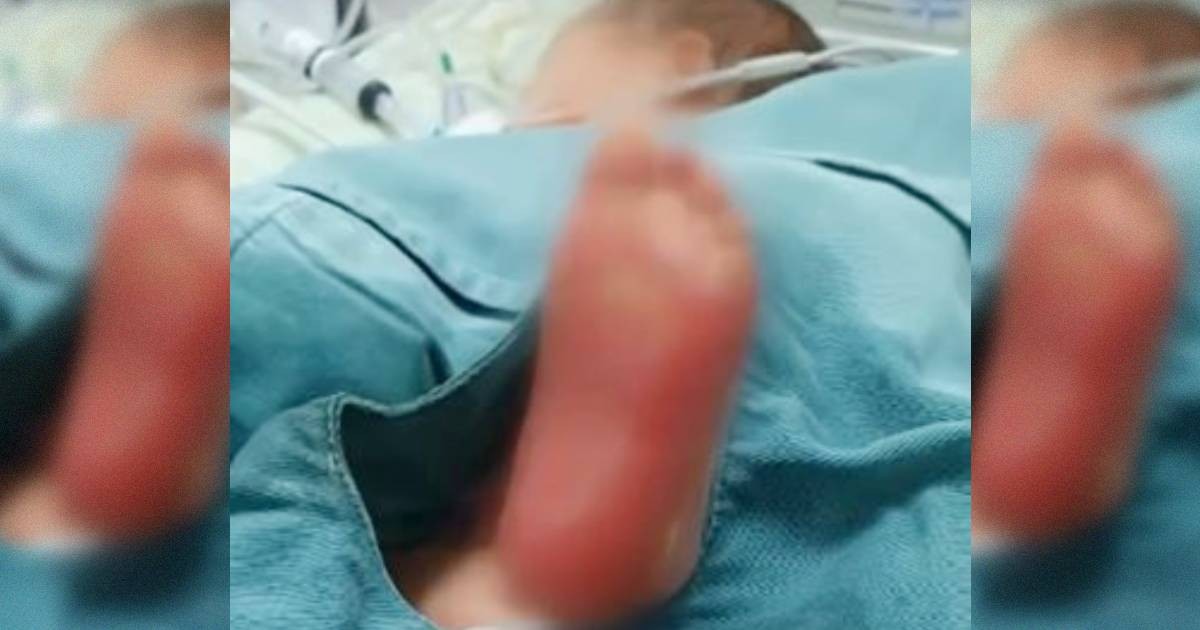Mãe denuncia queimadura em recém-nascido durante preparação para teste do pezinho, em Maringá