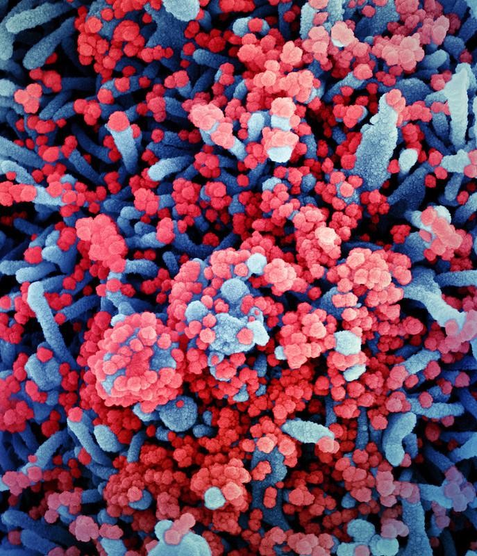 Célula (em azul) gravemente infectada pelo Sars-CoV-2 (em vermelho) (Foto: NIAID)