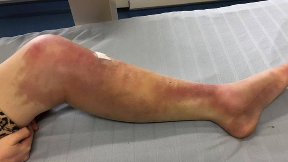 Os médicos não sabem quais as causas dos inchaços e da vermelhidão no corpo de Charlotte — Foto: Charlotte Evans/via BBC