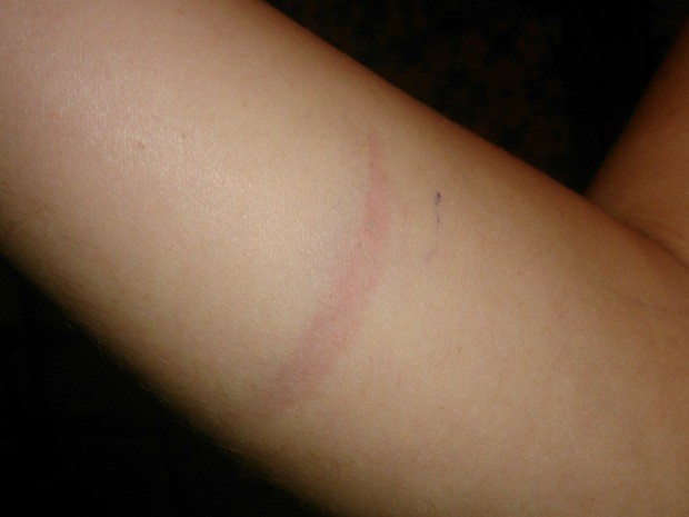 Mãe de aluna arranhou o braço de professora em São Vicente (Foto: LG Rodrigues / G1)