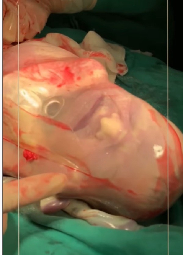 Bebê nasce empelicado (Foto: Reprodução Instagram/ Instituto Nascer)