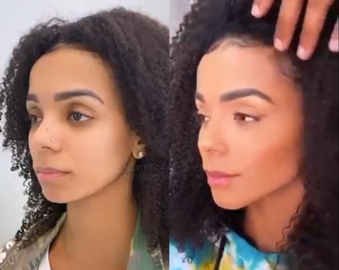 Brunna Gonçalves antes (esquerda) e depois (direita) da harmonização facial (Foto: Reprodução/Instagram)