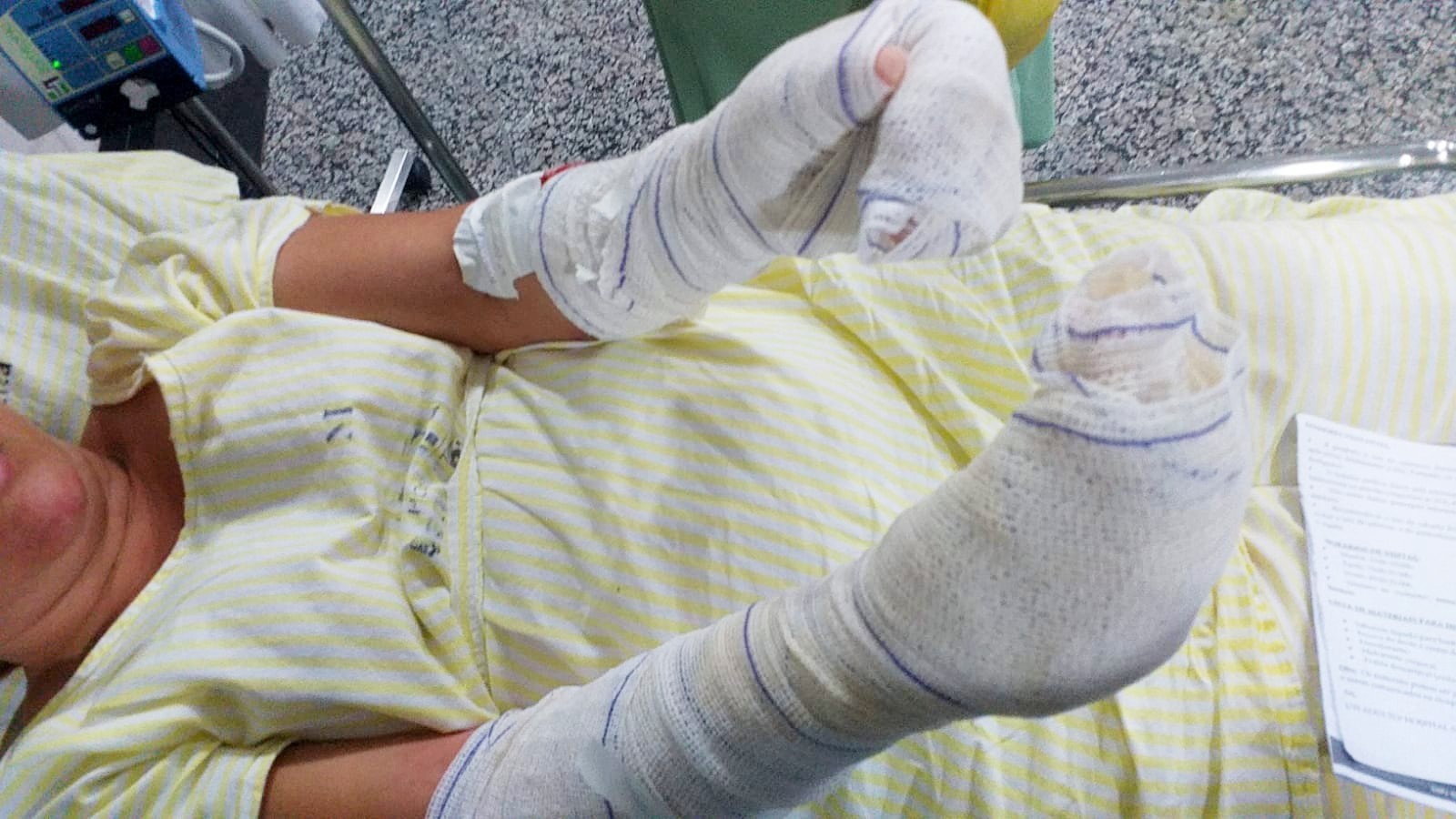 Criança que teve 65% do corpo queimado após explosão com álcool sai do coma em MS