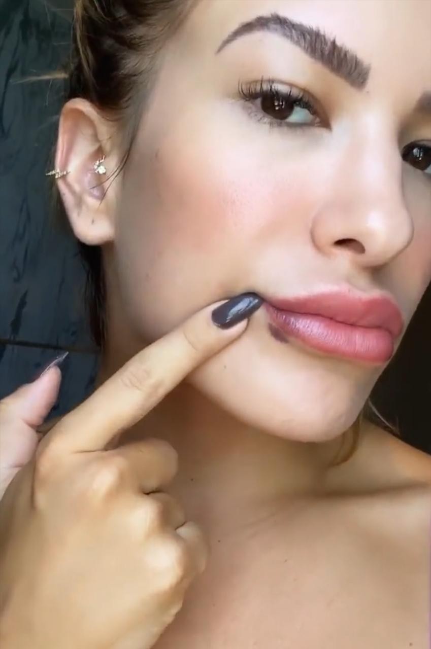 Lorena Improta mostra hematoma na boca após botox (Foto: Reprodução/Instagram)
