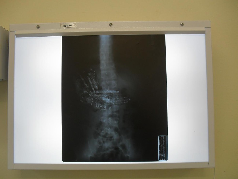 Preso foi submetido a uma cirurgia para a retirada dos celulares do estômago (Foto: SAP/Cedida)