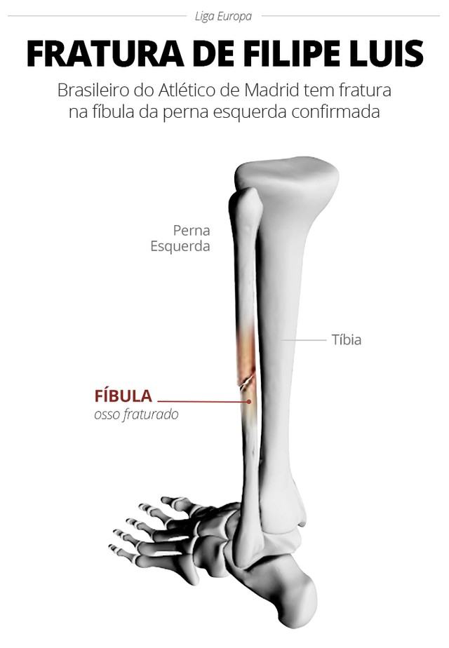 info-fratura-filipe-luis_b.jpg