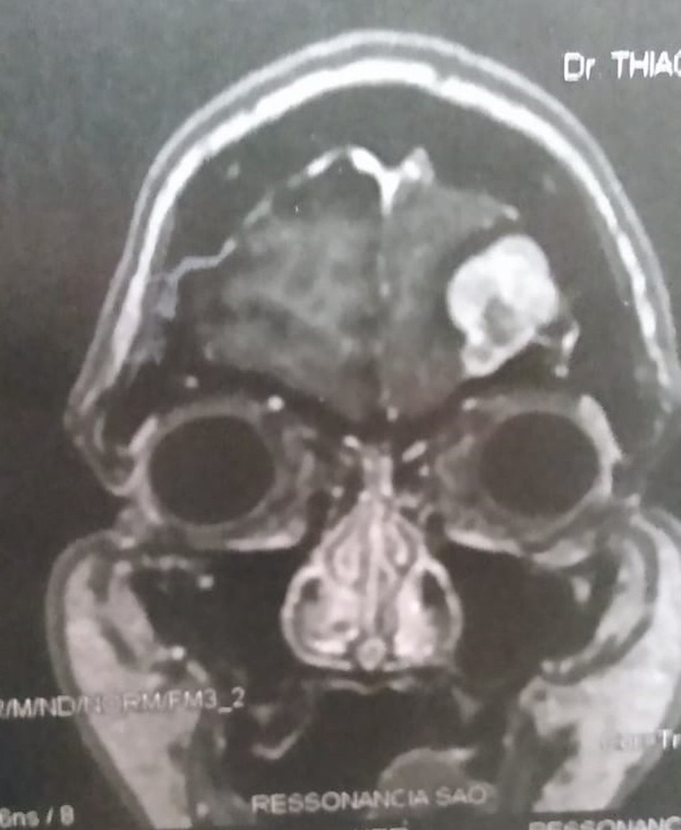 Tumor encontrado no cérebro da administradora Fabíola Barros (mancha branca sobre o olho) em Natal — Foto: Cedida