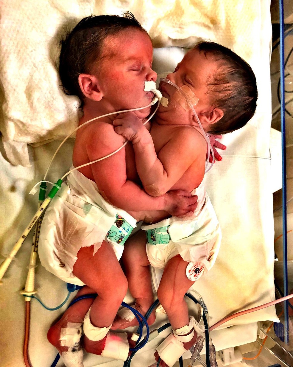 Sara e Eloá nasceram unidas pelo tórax. — Foto: Redes Sociais/Reprodução
