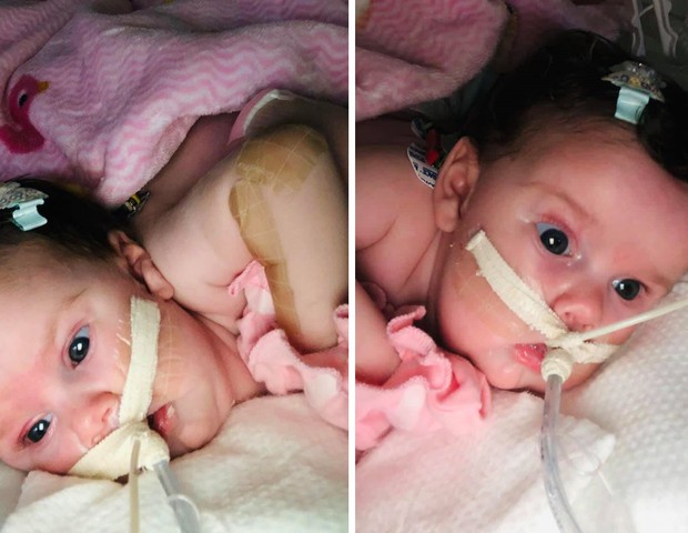 Gêmeas Sara e Aloá nasceram siamesas (Foto: Reprodução Facebook)