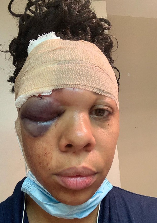 Americana tem olho ferido com tiro de borracha durante manifestação em Fort Lauderdale (Foto: Reprodução/Instagram)