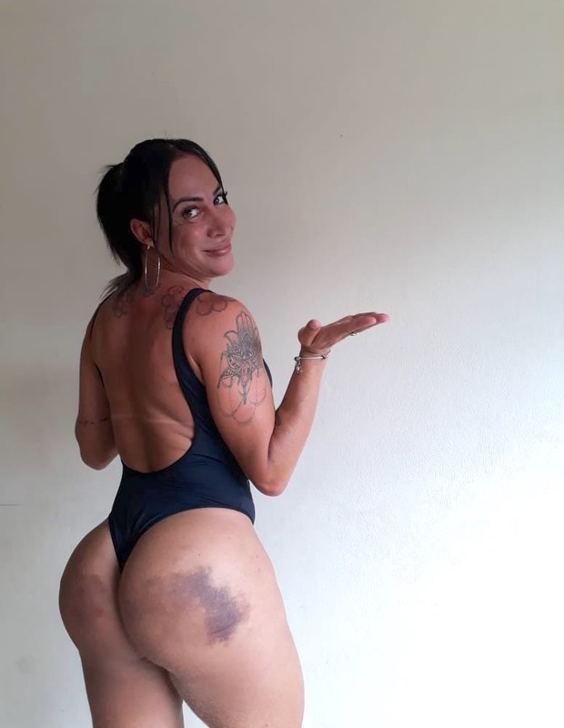 A ex-Miss Bumbum Pâmella Michelinny  mostra hematomas após procedimento (Foto: Divulgação)