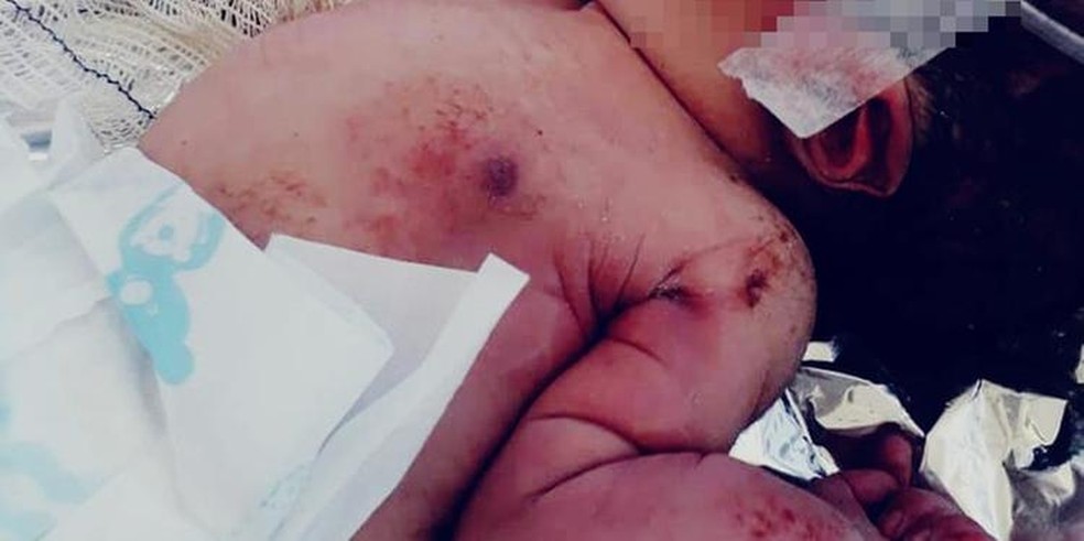 RecÃ©m-nascido machucado e com braÃ§o quebrado Ã© abandonado em Ã¡rea de construÃ§Ã£o em AcarÃ¡, no ParÃ¡ â Foto: ReproduÃ§Ã£o