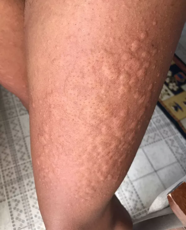 Homem E Atacado Por Aranha Ao Vestir Roupa E Tem Reacao Alergica No Maranhao Maranhao G1