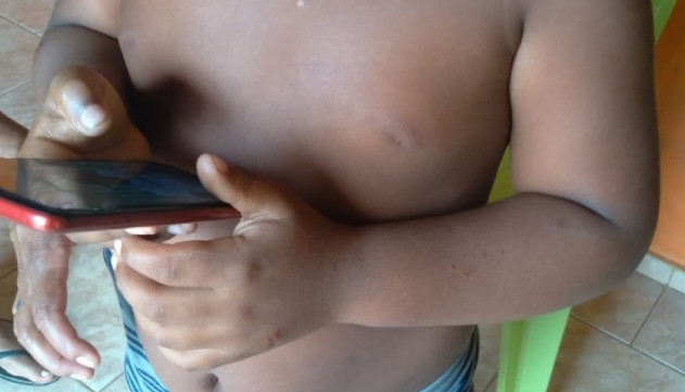 Menino de sete anos é atacado por pitbull no Maranhão; criança ficou com sequela no rosto