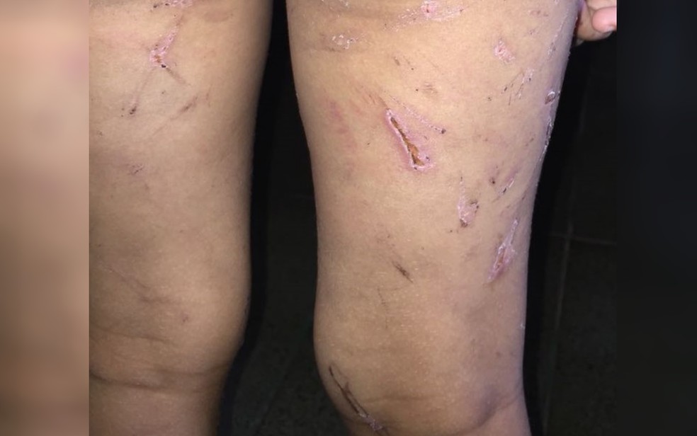 CrianÃ§a apresentava lesÃµes e hematomas por diversas partes do corpo (Foto: PolÃ­cia Civil/DivulgaÃ§Ã£o)