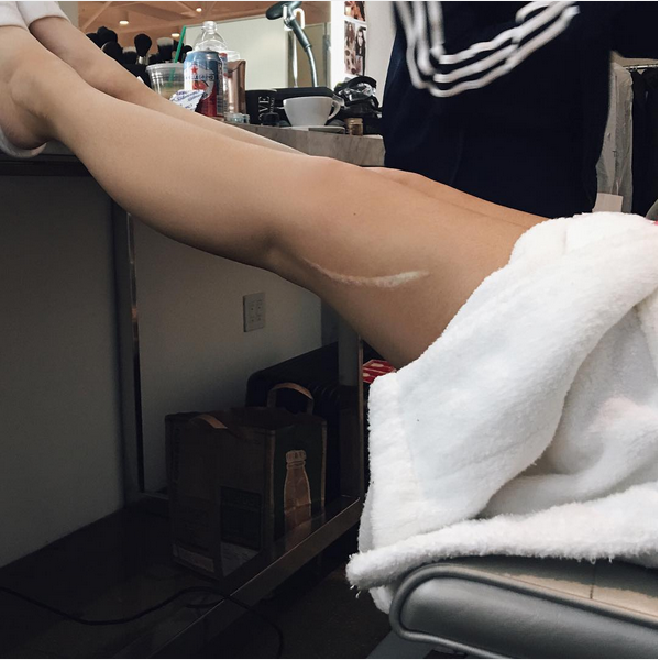 A cicatriz de Kylie Jenner (Foto: Instagram)