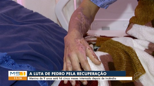 Menino de 9 anos que teve 85% do corpo queimado em incêndio tem recuperação lenta, conta pai