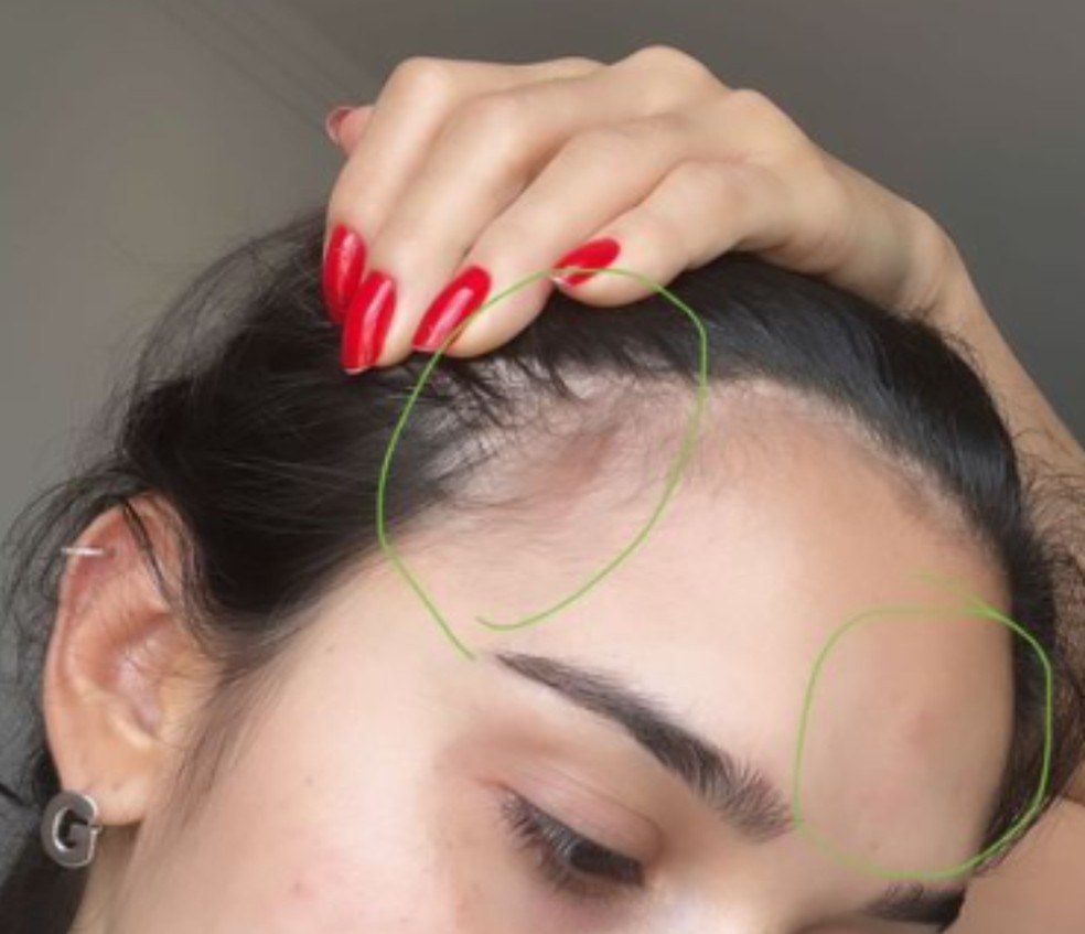 Influenciadora mostrou marcas roxas na cabeça e testa — Foto: Redes sociais