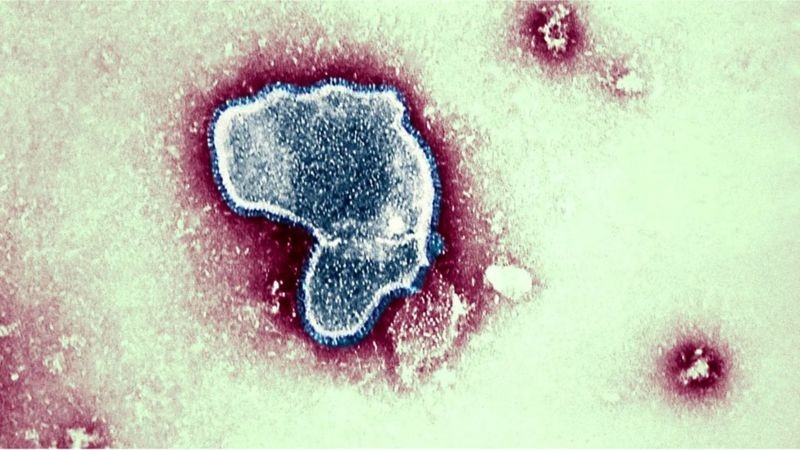 Vírus Sincicial Respiratório em geral produz quadros semelhantes a um resfriado, mas em alguns casos pode provocar bronquiolite em crianças pequenas (Foto: Getty Images via BBC News)