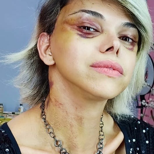 Léo Áquilla surge com olho roxo por causa de procedimento e deixa fãs assustados (Foto: Reprodução/ Instagram)