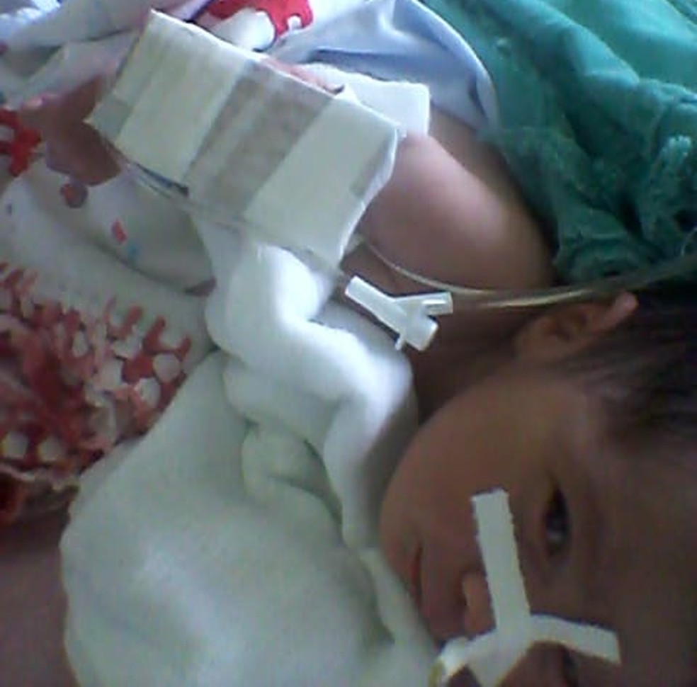 Recem Nascido Com Malformacao No Intestino Passa Por Cirurgia E Esta Na Uti Em Rio Branco Acre G1