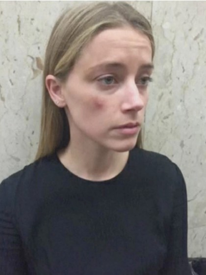 Machucado de Amber Heard que, segundo Johnny Depp, teria sido feito com maquiagem. A foto foi feita em um tribunal de Los Angeles (Foto: Reprodução YouTube)
