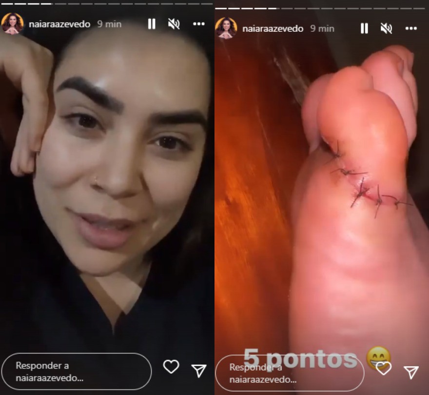 Naiara Azevedo cortou dedinho do pé e precisou levar pontos (Foto: Reprodução/Instagram)