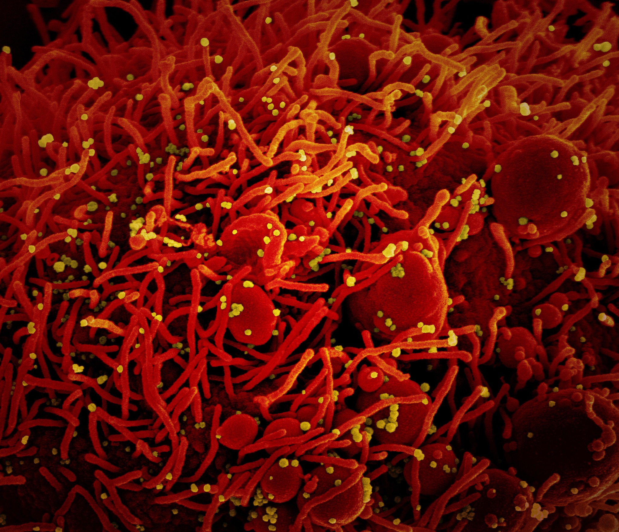 Micrografia eletrônica colorida de uma célula apoptótica (vermelha) infectada pelo Sars-CoV-2 (amarelo) (Foto: NIAID)