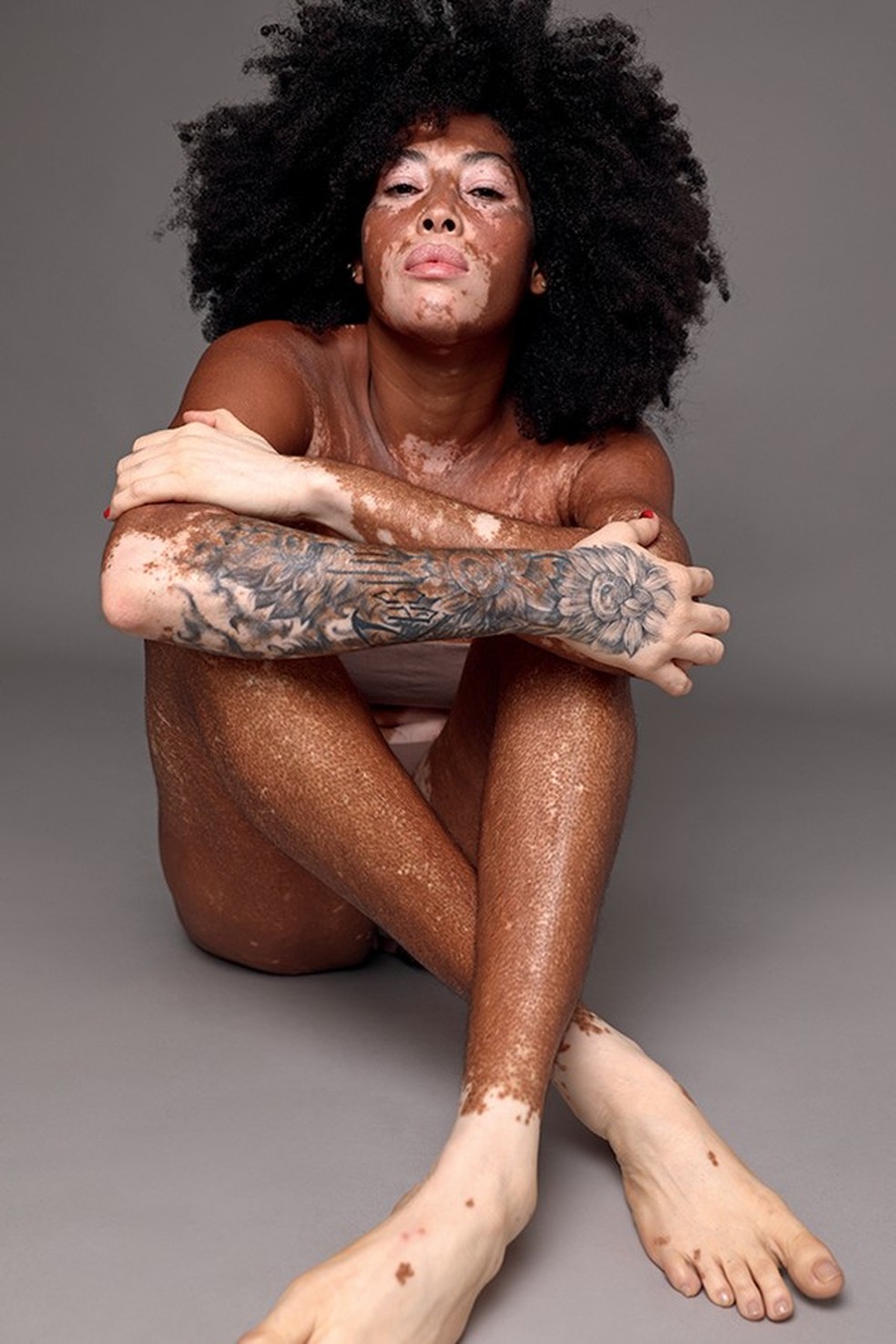 Vitiligo: te contamos tudo sobre a doença autoimune | Pele | Glamour
