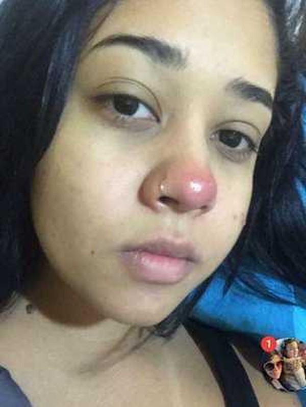 Fiquei Paraplegica Por Causa De Um Piercing Ciencia E Saude G1