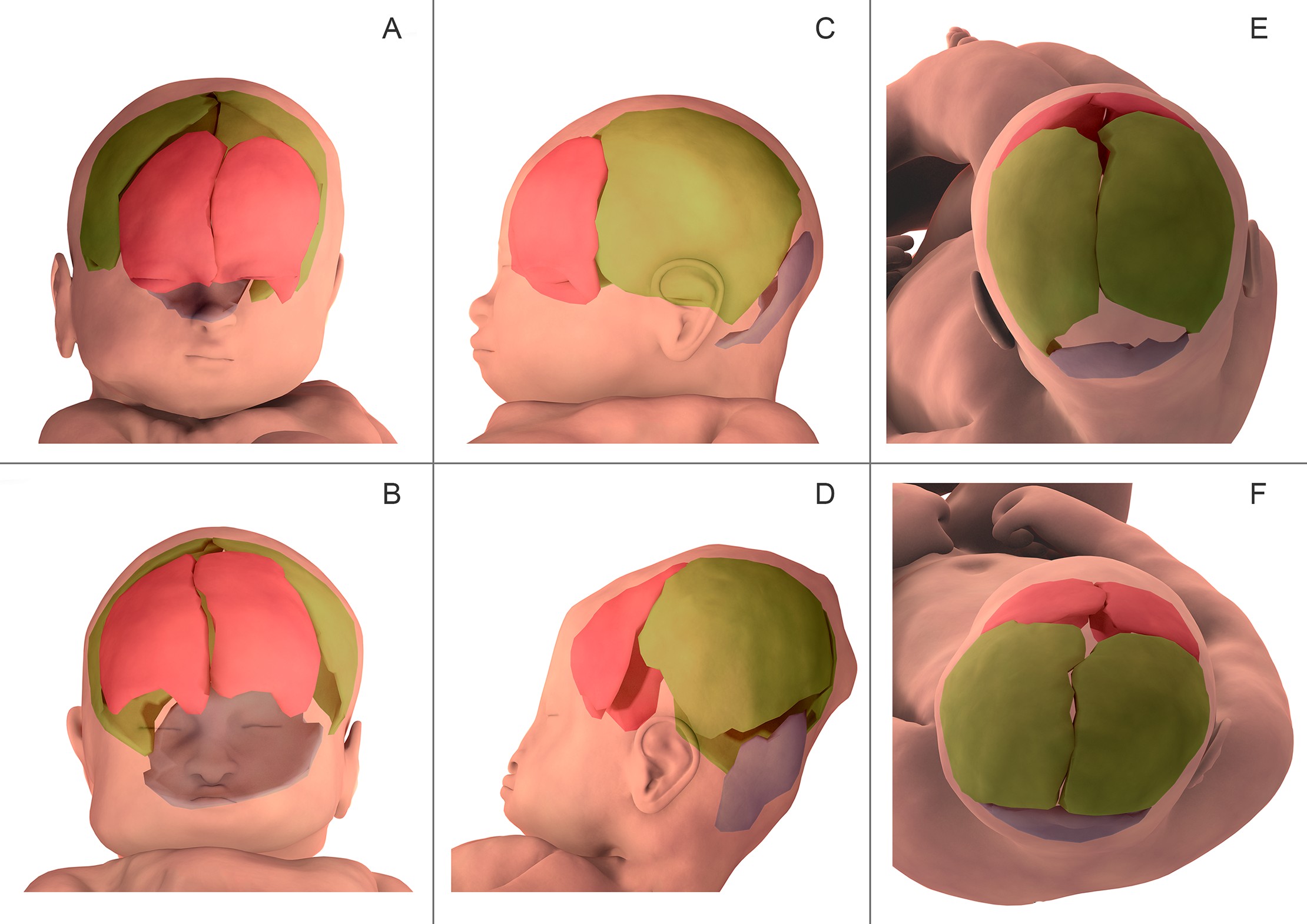 Reconstrução tridimensional de elementos finitos dos ossos cranianos antes do trabalho de parto (A, C, E) e durante o segundo estágio do trabalho de parto (B, D, F) no paciente 5. Os ossos frontais estão marcados em rosa, ossos parietais em verde e o osso occipital em azul. Na visão anterior (A, B), observou-se que a fontanela bregmática (popularmente conhecida como moleira) diminuiu de tamanho durante o parto. Na visão lateral (C, D), os ossos do crânio foram alterados em orientação relativa e quantidade de sobreposição. Na visão superior (E, F), as fontanelas bregmáticas e lambdoides diminuíram de tamanho durante o parto. (Foto: Ami et al., 2019)