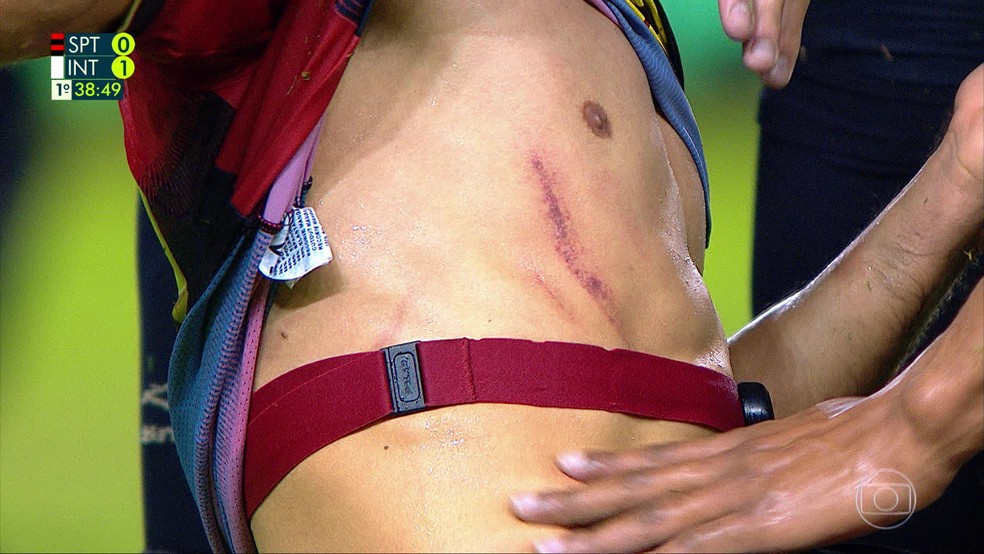 Entrada de Patrick, do Internacional, deixa marca da chuteira em Ricardinho, do Sport — Foto: Reprodução