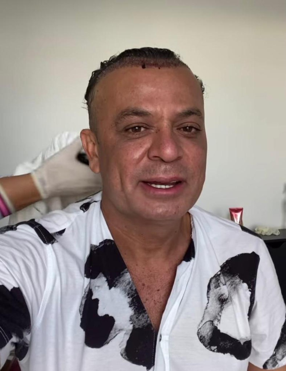 Frank Aguiar compartilhou o procedimento com os fãs  — Foto: Reprodução/Instagram