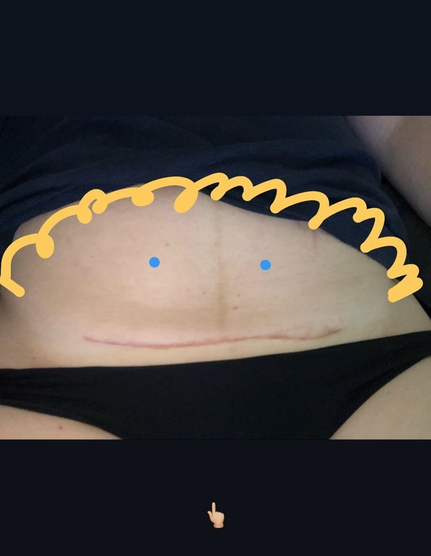 Amy Schumer mostra cicatriz da cesariana (Foto: Reprodução/Instagram)