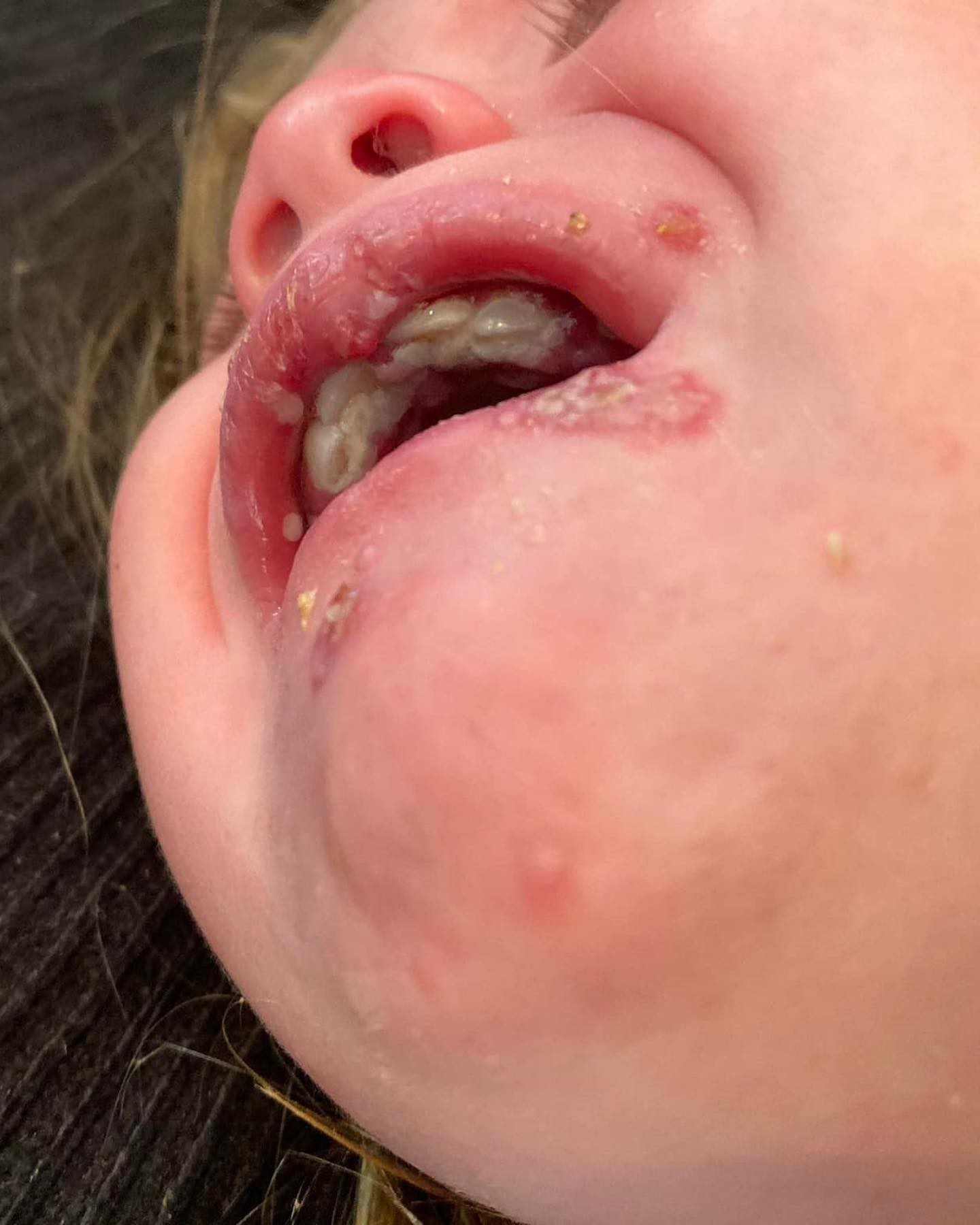 Sadie sofreu com herpes, vírus transmitido pelo beijo de um adulto (Foto: Reprodução/ Instagram)