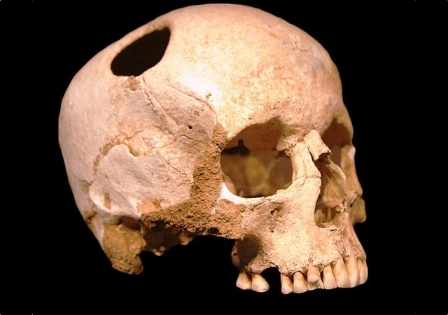 um crânio do neolítico que passou por uma trepanação (Foto:  Natural History Museum, Lausanne/Rama)