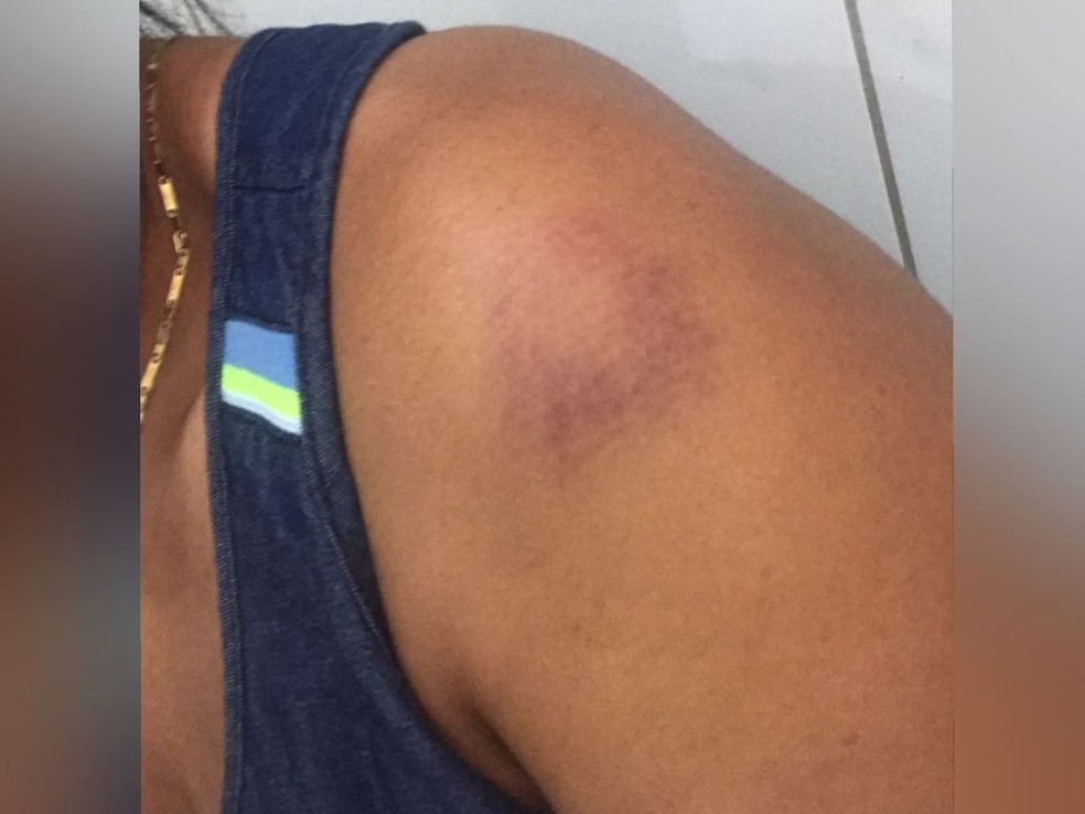 Sâmia Gomes Brigido afirma que foi atingida no ombro por uma garrafa de vidro arremessada pelo coreógrafo. — Foto: Arquivo pessoal