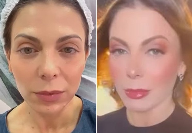 Sheila Mello antes e depois de retocar botox (Foto: Reprodução/Instagram)
