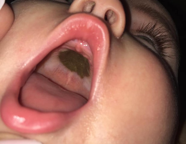 Mãe assustou ao ver a mancha escurecida no "céu da boca" da bebê (Foto: Reprodução Facebook)