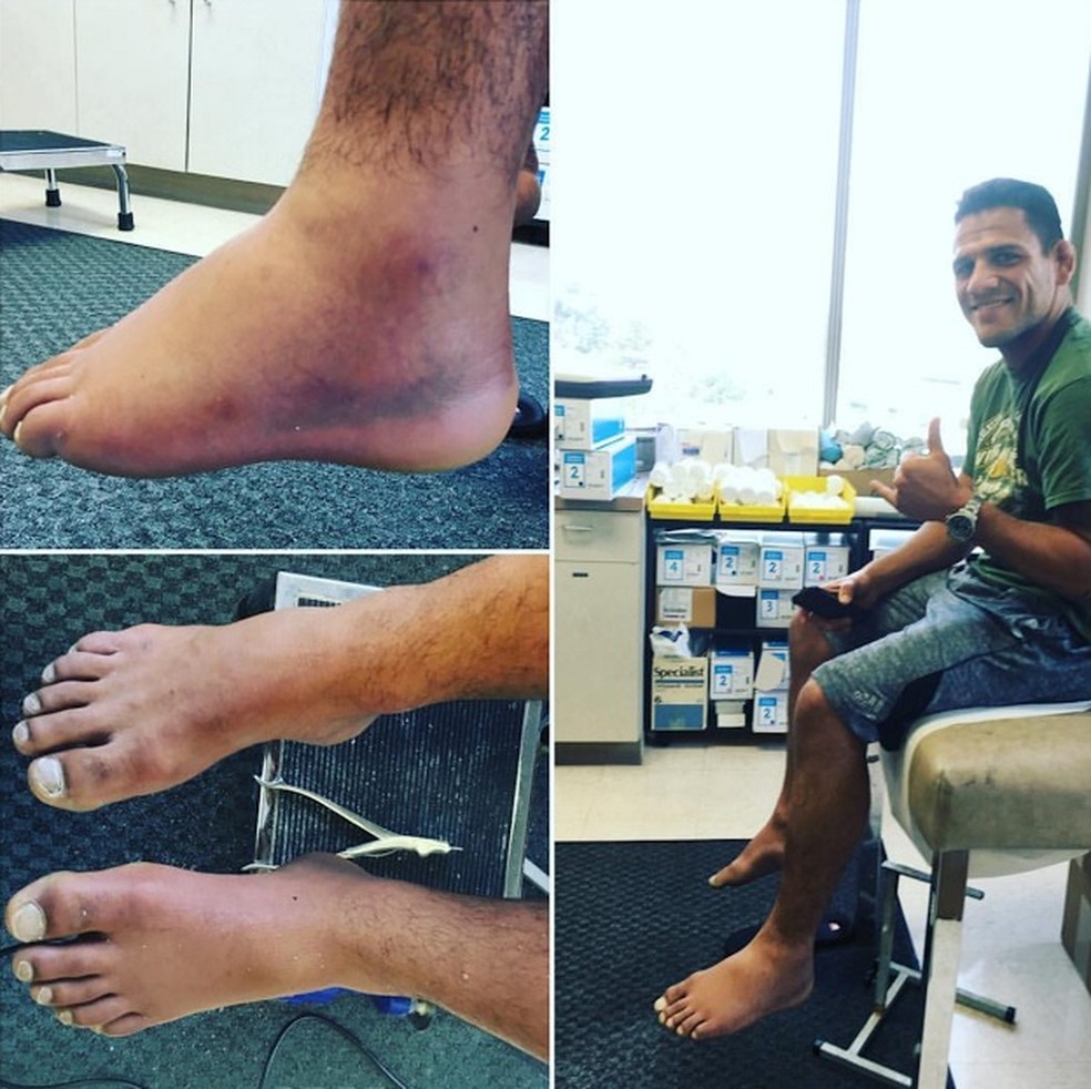 Lesão no quinto metatarso do pé esquerdo tirou Rafael dos Anjos de luta contra Conor McGregor, em 2016 (Foto: reprodução/Facebook)