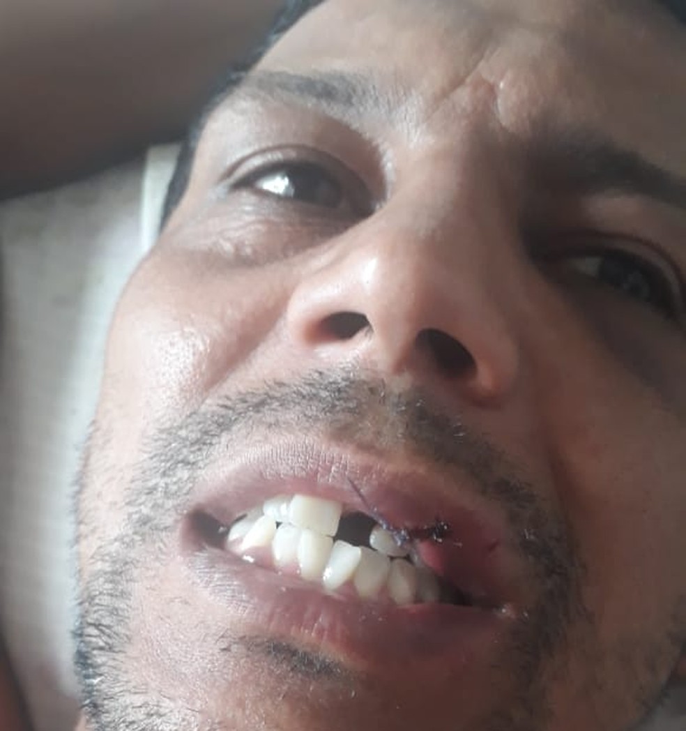 Sérgio com lesões na boca e sem um dente; ele foi confundido como torcedor do Flamengo e por isso foi agredido — Foto: Arquivo pessoal 