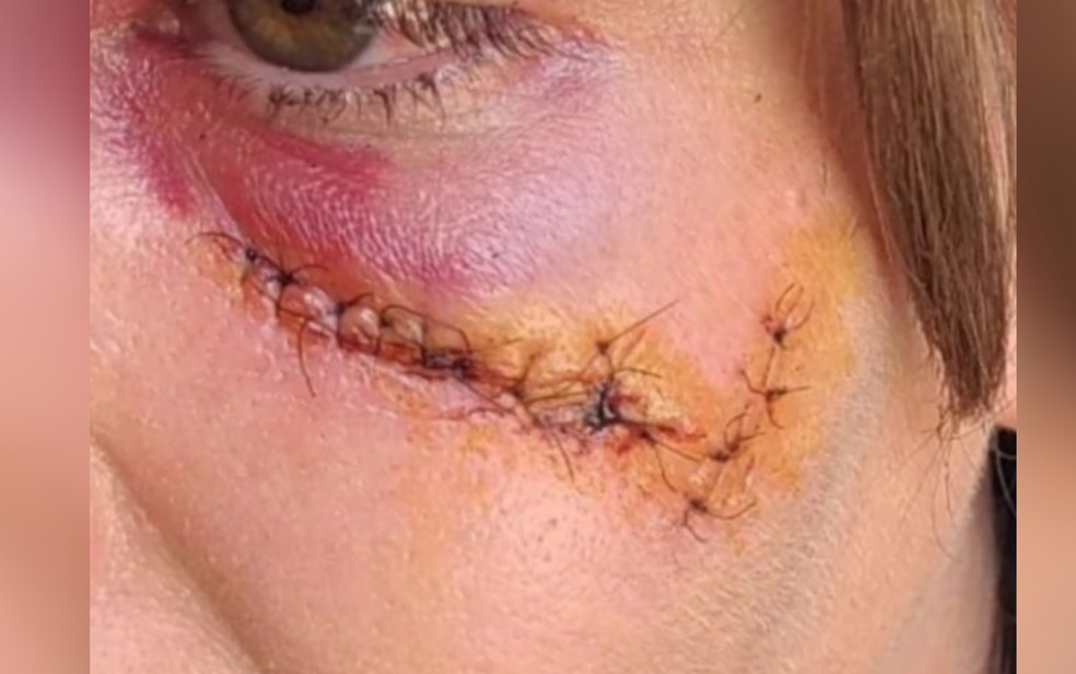 Empresria leva mais de 20 pontos no rosto aps ser agredida pelo ex-namorado, em Nerpolis, Gois  Foto: Arquivo pessoal