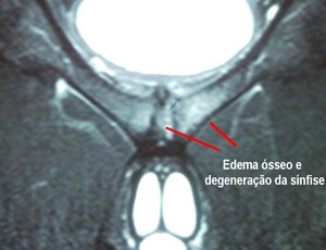 Pubalgia: incidência é maior no futebol e tênis, e pode comprometer ...