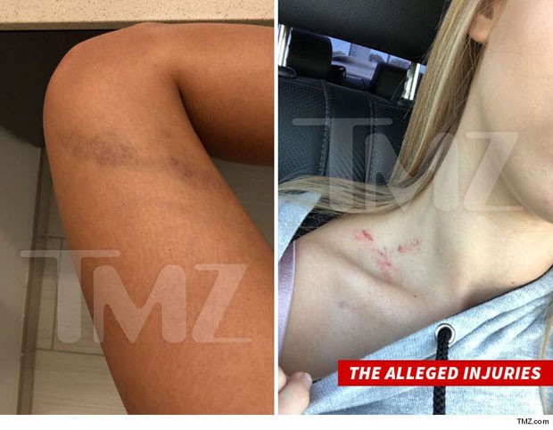 Fotos dos ferimentos de Alexa divulgadas pelo TMZ (Foto: TMZ)