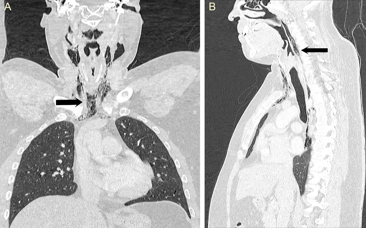 Radiografias que apontam a lesão na faringe (Foto: Head and Neck Surgery, University Hospitals of Leicester NHS Trust)