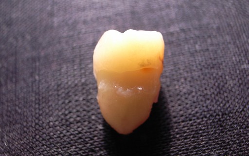 Cisto Com Dente E Cabelo E Encontrado Em Ovario De Paciente Revista Galileu Saude