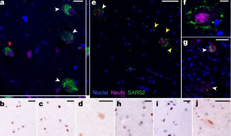 Proteína do vírus Sars-CoV-2 e expressão de RNA em tecido cerebral humano